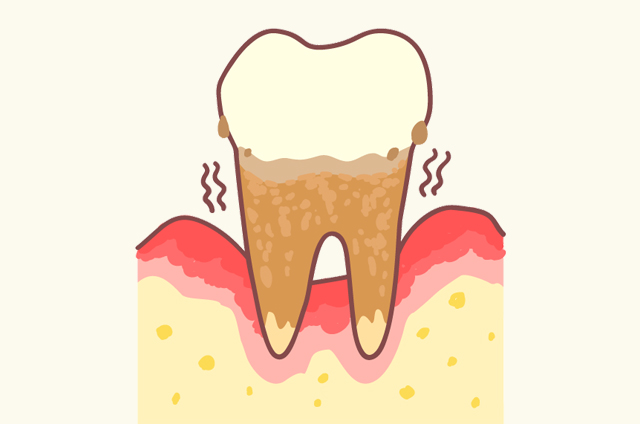 大きくなった歯石は歯と歯茎の間にも入り込みます